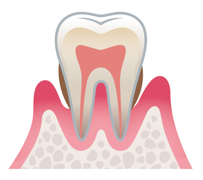 川上歯科あべの診療所 中度の歯周炎