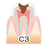 川上歯科あべの診療所 虫歯の進行度C3