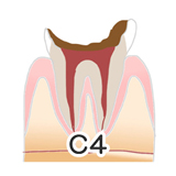 川上歯科あべの診療所 虫歯の進行度C4